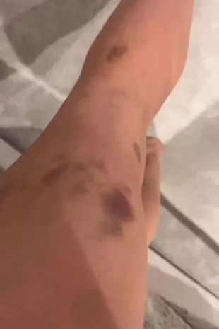 《太阳上的一个地方》的劳拉·汉密尔顿对潜在致命的自身免疫性疾病进行了最新报道